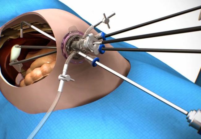 Laparoscopic Surgery in Ernakulam