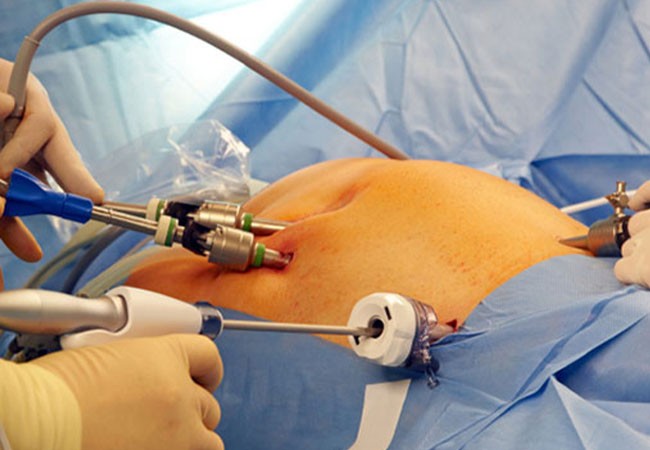 laparoscopic-surgery-a